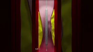 Coronary Artery Stent Placement (Animation)
