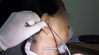 Removing Elderly Woman's Terrible Earwax with Hydrogen Peroxide