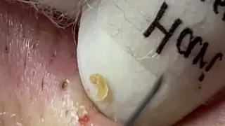 Blackheads Removal with Hari's - Satisfying