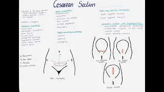 Cesarean Section - Types, Indications, Incisions etc