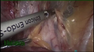 Laparoscopic Lateral wall Anatomy