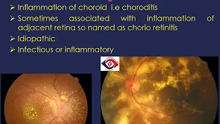 Uveitis by Dr Sadia Bukhari