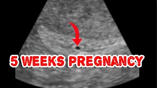 Early pregnancy sac on ultrasound (Intradecidual sac sign)