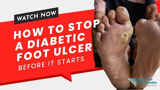 How to Stop a Devastating Diabetic Foot Ulcer Before It Starts