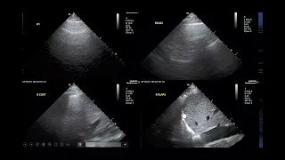 Normotensive Cardiogenic Shock