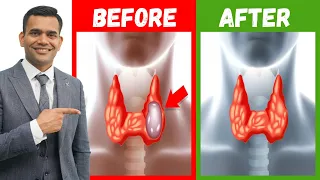 How To Shrink Thyroid Nodules Naturally | Effective Natural Treatment Of Thyroid Nodules