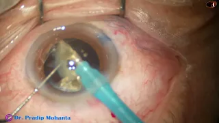 Managing an Intumescent cataract with Hard nucleus - Pradip Mohanta, 2nd Feb, 2024