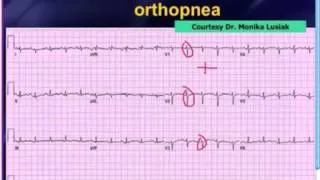 Mattu EKG Vakası - 12 Mart 2013