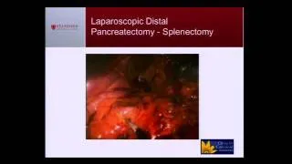 Surgery for Neuroendocrine Tumors: Laparoscopic Approaches