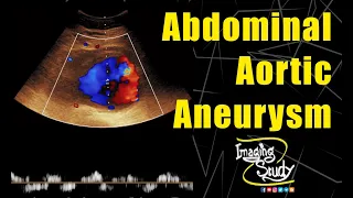 Abdominal Aortic Aneurysm || Ultrasound || Doppler || Case 139