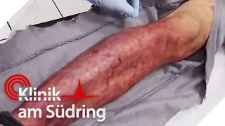 Muss das Bein amputiert werden? Es verfault! | #FreddyFreitag | Klinik am Südring | SAT.1 TV