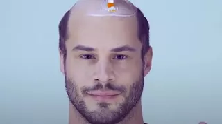 Ultra realistic hair pieces give bald men hair again