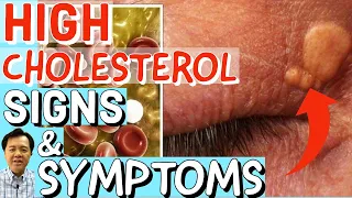 High Cholesterol Signs and Symptoms - By Doc Willie Ong