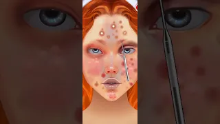 Clear Skin Secrets | Expert Treatment of Blackheads and Hidden Acne Processing