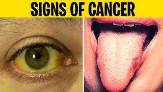 10 WARNING Signs of CANCER You Must Not Ignore