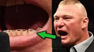 What's Wrong with Brock Lesnar's Teeth? 10 Shocking Things on WWE Wrestlers