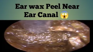 EARDRUM PEEL & EAR WAX REMOVAL- EP-13
