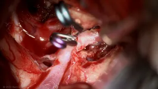 Microsurgical Clipping of a Ruptured Anterior Communicating Artery Aneurysm