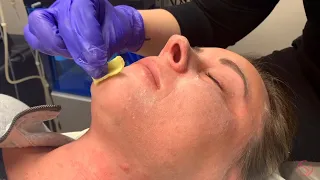 ZO 3-Step Peel at The Dermatology Laser and Vein Center