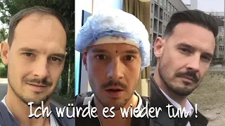 Wichtige Informationen ! Was passiert nach einer Haartransplantation mit dem Kopf.