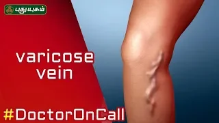 Varicose Veins: வெரிகோஸ் வெயின் தீர்வு என்ன? Doctor On Call | 12/07/2019