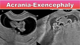 Acrania- Exencephaly