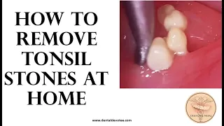 How to remove tonsil stones at home - Tonsil stone removal