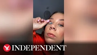 Woman shares clip of her popping a spot under her eyelid