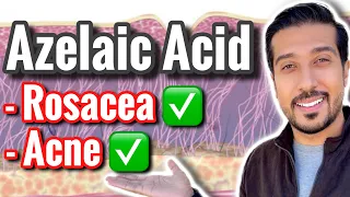 Azelaic Acid for Acne and Rosacea | How to Use Azelaic Acid Like a PRO 🏆