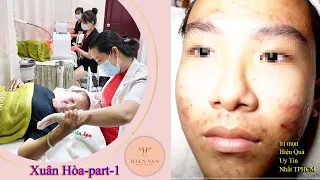 How to remove the various of acnes at hien van spa-part 1|341|Xuân Hòa