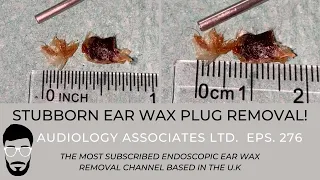 12 DAYS OF WAXMAS - EAR WAX REMOVAL DAY 10 - EP 276