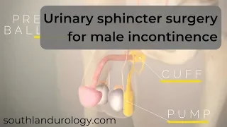 Urinary sphincter surgery for male stress incontinence | AMS 800