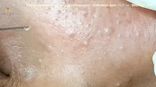 How to pop acne,lackheads,cyst under skin at Hien Van Spa-413