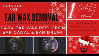 DARK EAR WAX PEEL FROM EAR CANAL & EARDRUM - EP 402