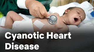 Cyanotic Heart Disease | Congenital | Cardiology | Neonatology | Graphic Era Hospital | GEIMS