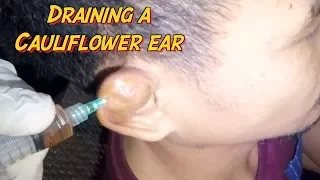 How to Drain A Cauliflower Ear