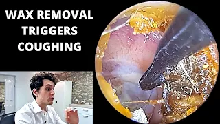 Vagus Nerve Stimulated During Ear Wax Removal (Arnold's Reflex)