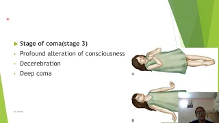 Tubercular meningitis in  children