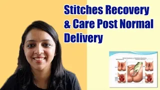 Post Normal Delivery Stitches Recovery & Care Tips