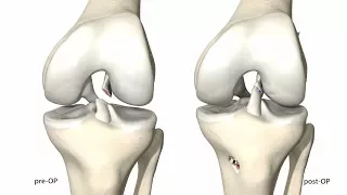 Mathys: Ligamys surgical technique, Animation