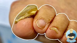 BIG THICK TOENAIL FINALLY GETS TRIMMED DOWN