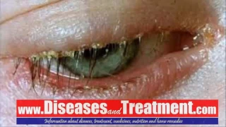 Blepharitis : causes, symptoms, diagnosis, treatment, complications, risk factors, prevention