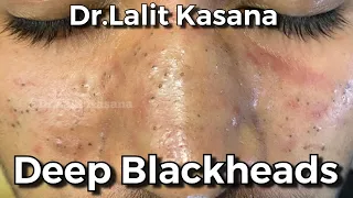 Deep BLACKHEAD Removal by Dr.Lalit Kasana / New Video