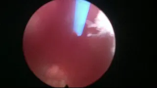 Real Life HoLEP case nº 15: trilobar prostate with narrow urethral lumen