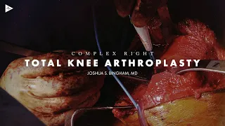 Complex Right Total Knee Arthroplasty by Joshua S. Bingham, MD | Preview