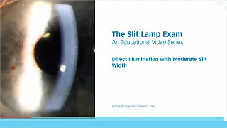 The Slit Lamp Exam – Episode 4, Direct Illumination with Moderate Slit Width