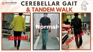 Cerebellar Ataxia #Gait #Abnormal #TandemWalk  #neurology #widebasegait #tandemgait #meded