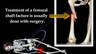 Fracture of the  Femur and  its  fixation - Everything You Need To Know - Dr. Nabil Ebraheim