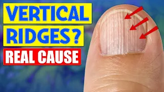 The Real Causes Behind Vertical Ridges On Nails Unveiled