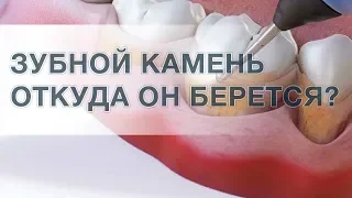 Что такое зубной камень? Нужно ли удалять камень?